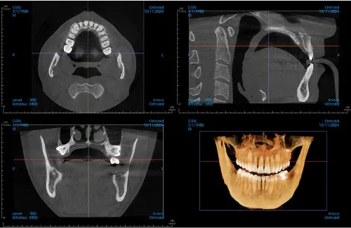 RayScan Quantum CBCT