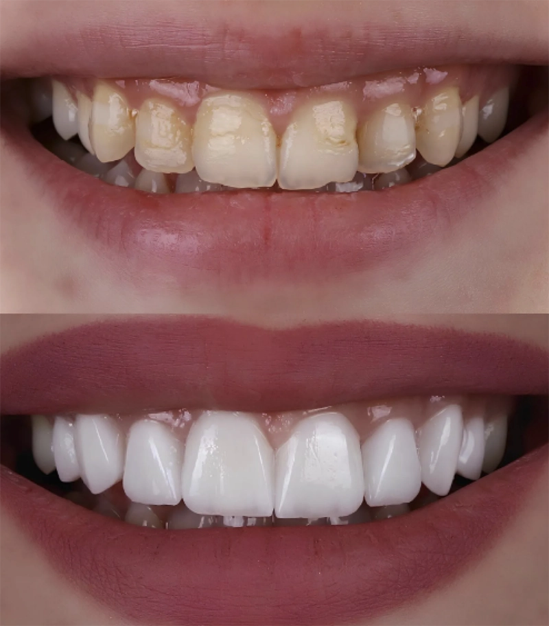 before and after crowns and veneers
