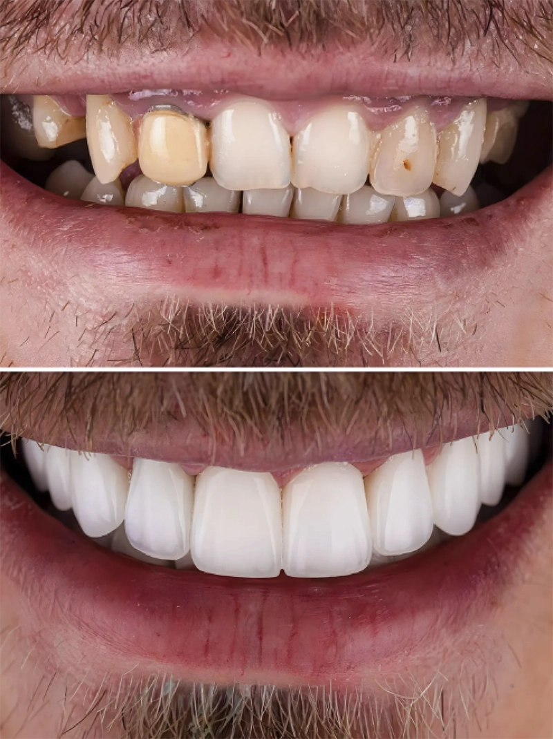 man's teeth before and after with restored smile
